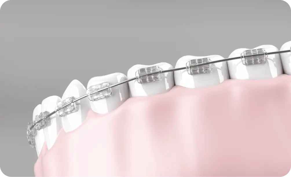 マルチブラケットシステム